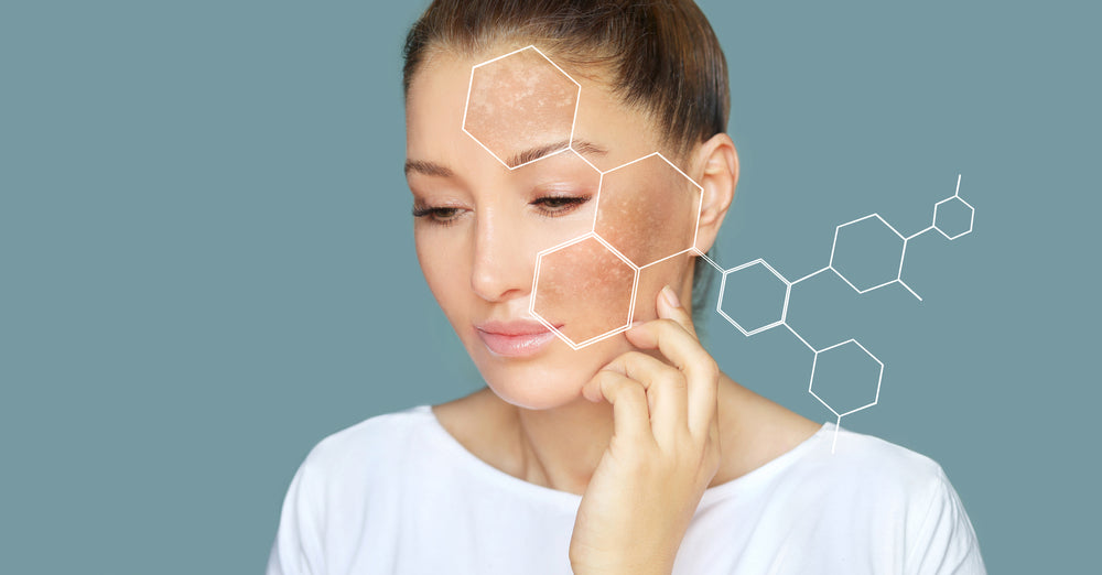 How To Reduce And Prevent Hyperpigmentation